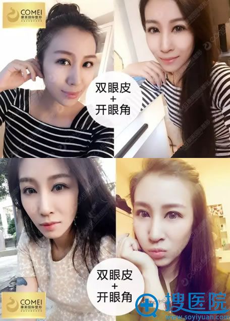 <!--<i data=20240710 data-id=15772></i>-->整形医院双眼皮案例 <!--<i data=20240710 data-id=15772></i>-->整形医院双眼皮案例