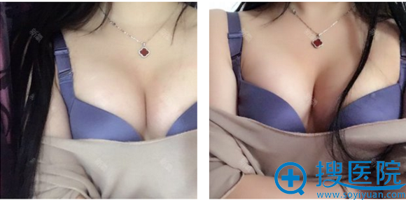 上海九院曹卫刚自体脂肪隆胸案例术后半个月图片