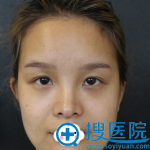 深圳贝漾美天曹思佳双眼皮案例