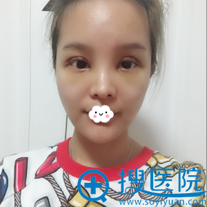 深圳贝漾美天曹思佳眼部综合整形案例