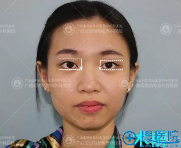 做双眼皮和假体下巴手术前