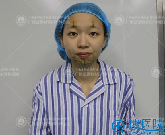 南宁爱思特李俊明主任设计的手术方案