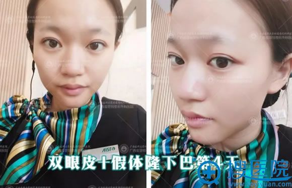 南宁爱思特员工做完双眼皮术后4天效果