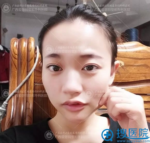 南宁爱思特双眼皮和下巴案例15天效果