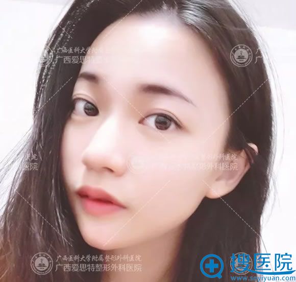 南宁爱思特双眼皮和下巴术后1个月