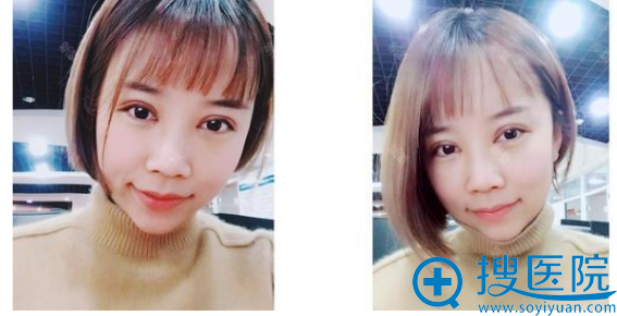 西安韩媚整形医院王仁根双眼皮术后七天拆线