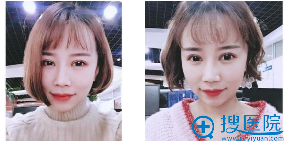 西安韩媚整形医院王仁根院长双眼皮案例术后一个月图片