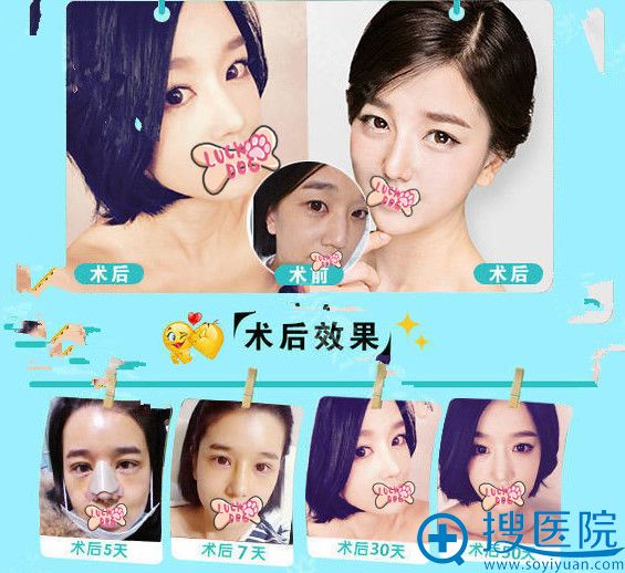 <!--<i data=20240710 data-id=13118></i>-->王文革院长鼻综合整形案例及恢复过程图