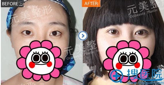 <!--<i data=20240710 data-id=13118></i>-->整形王文革双眼皮整形案例前后对比图