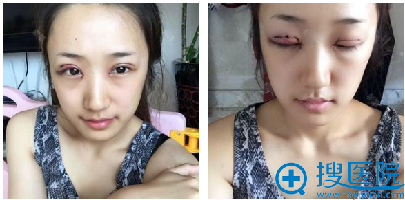 上海瑰康医疗美容医院王屏双眼皮案例术后即刻效果