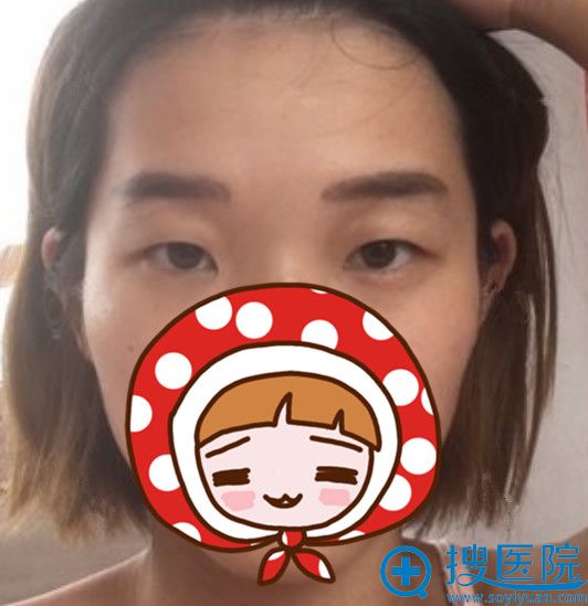 去<!--<i data=20240710 data-id=11471></i>-->整形美容医院做全切双眼皮+开内眼角手术前样子