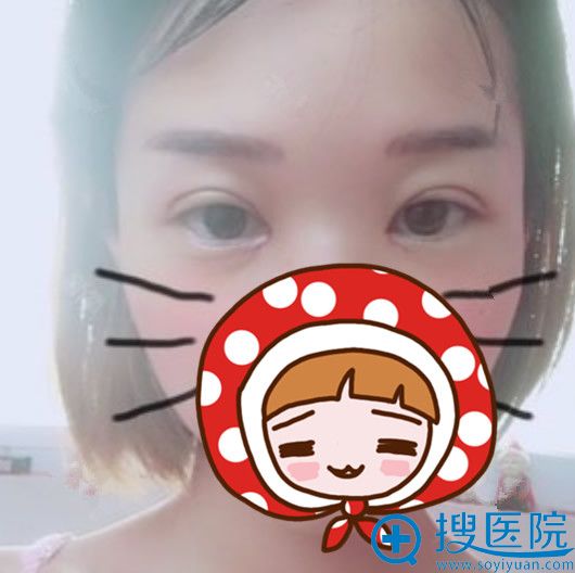 <!--<i data=20240710 data-id=11471></i>-->整形割双眼开眼角术后第7天拆线后照片