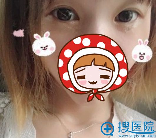 时光整形全切双眼皮+开内眼角术后3个月效果图