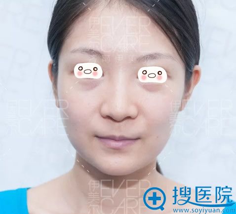 <!--<i data=20240710 data-id=12670></i>-->整形自体脂肪填充全脸术前照