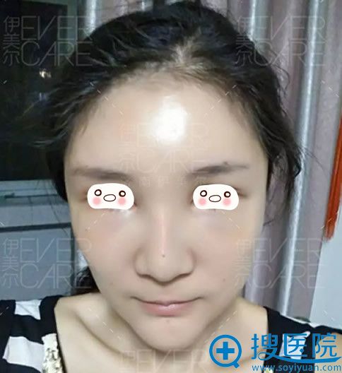 伊美尔整形自体脂肪填充面部术后第1天样子