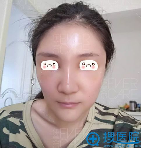 在<!--<i data=20240710 data-id=12670></i>-->整形面部填充自体脂肪术后第5天恢复效果