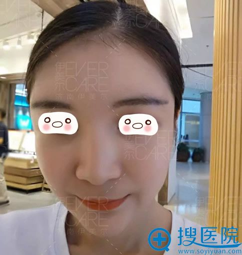 去<!--<i data=20240710 data-id=12670></i>-->整形做面部自体脂肪填充术后第15天照片