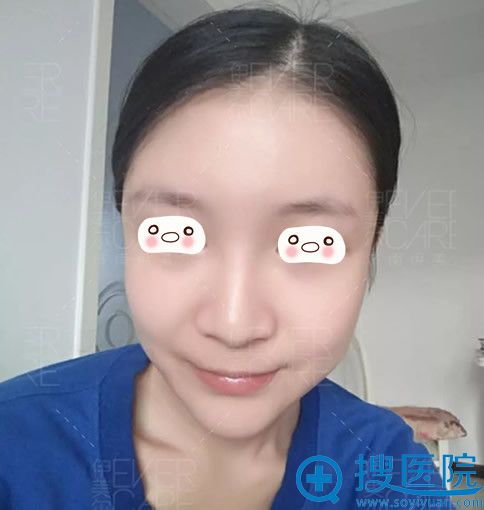 <!--<i data=20240710 data-id=12670></i>-->整形医院面部自体脂肪填充术后第25天效果图