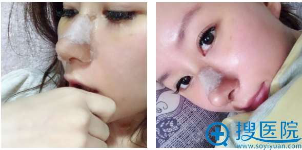 上海九院整形医生顾清鼻综合隆鼻术后第六天图片