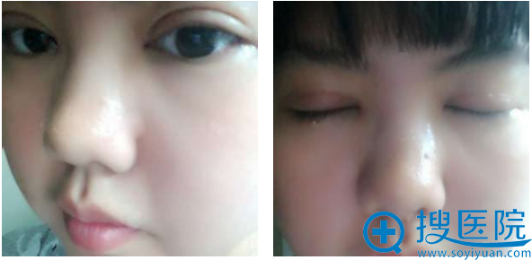 上海九院整形科顾斌切开双眼皮术后半个月恢复图片