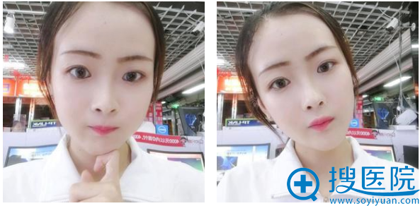 上海九院整形科徐梁医生下颌角磨骨案例术后三个月图片