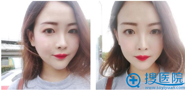 上海九院整形科徐梁医生下颌角磨骨术后两个月图片