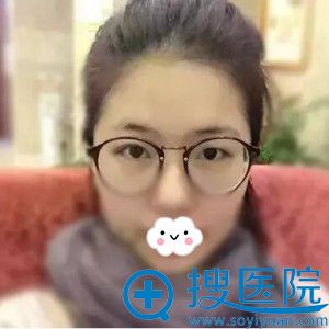 想做埋线张高贵建议切开双眼皮效果怎么样？