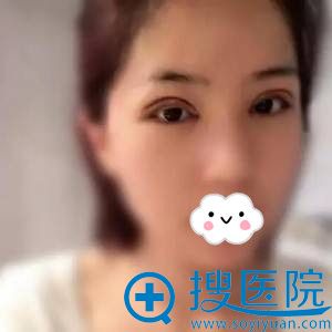 张高贵全切双眼皮真人案例