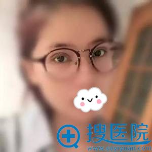 张高贵切开双眼皮术后效果展示