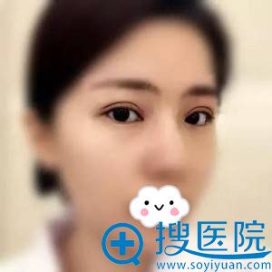张高贵医疗美容门诊部割双眼皮效果怎么样