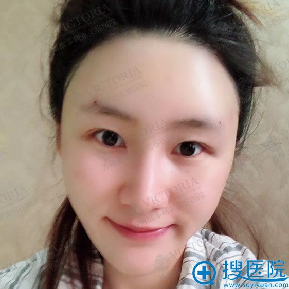<!--<i data=20240710 data-id=12122></i>-->潘杰脂肪填充案例即刻效果