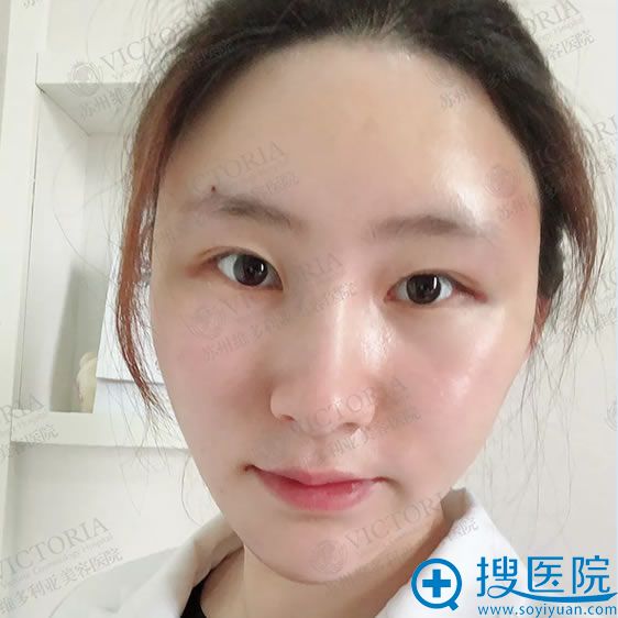 做完自体脂肪填充术后1天效果