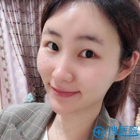 <!--<i data=20240710 data-id=12122></i>-->潘杰自体脂肪填充案例