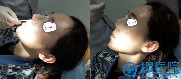 梁青松院长给我做达拉斯综合隆鼻手术中
