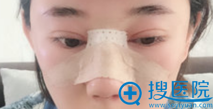 在<!--<i data=20240710 data-id=13602></i>-->做鼻综合隆鼻术后第2天样子