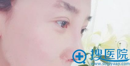 找梁青松做硅胶假体鼻综合隆鼻第7天拆线图