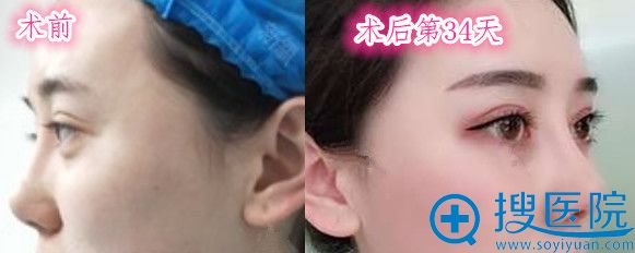 新疆<!--<i data=20240710 data-id=13602></i>-->鼻综合隆鼻前后对比照片展示