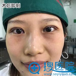 <!--<i data=20240710 data-id=12686></i>--><!--<i data=20240710 data-id=16640></i>-->双眼皮修复案例