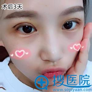 <!--<i data=20240710 data-id=12686></i>--><!--<i data=20240710 data-id=16640></i>-->双眼皮修复案例