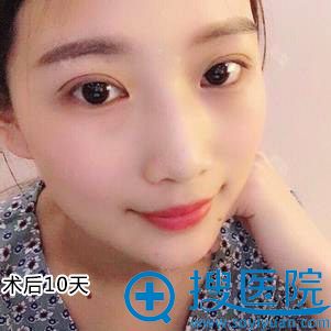 <!--<i data=20240710 data-id=12686></i>--><!--<i data=20240710 data-id=16640></i>-->双眼皮修复案例