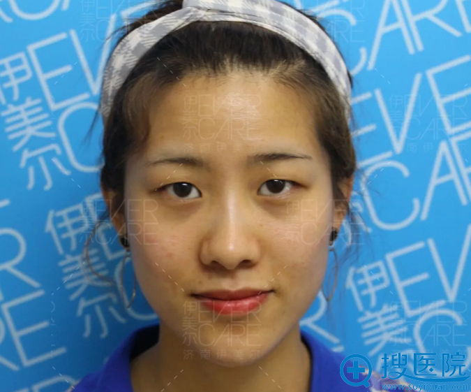 <!--<i data=20240710 data-id=12670></i>-->全切双眼皮+开内眼角真人案例