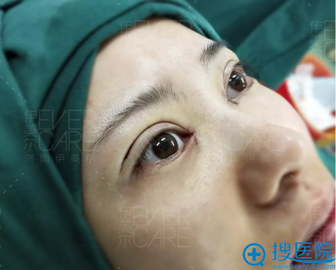 <!--<i data=20240710 data-id=12670></i>-->双眼皮+开眼角术后即刻效果