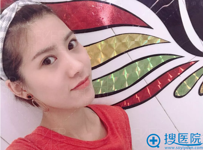 <!--<i data=20240710 data-id=12670></i>-->双眼皮术后恢复效果好吗