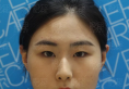 庆幸听了济南伊美尔王清峰主任的话把双眼皮和开眼角一起做了