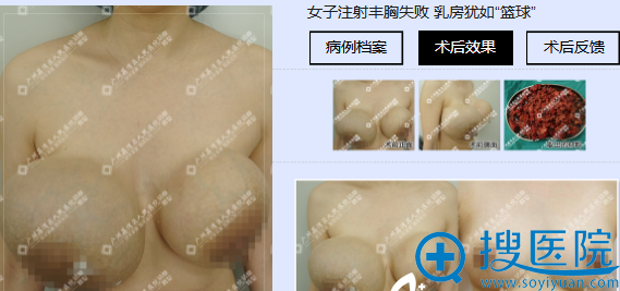广州市荔湾人民医院胸部奥美定取出案例图