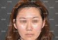 我叫小微,在北京柏丽做半肋隆鼻+面部脂肪填充后颜值提升不少
