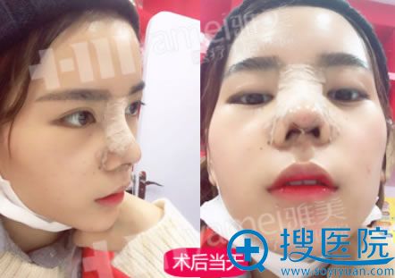 长沙雅美做鼻综合当天照片