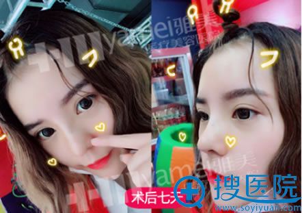 长沙雅美田芳斌教授隆鼻7天后