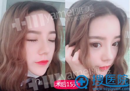 在长沙雅美隆鼻15天恢复照