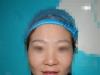 考虑到玻尿酸隆鼻效果不持久所以去郑州悦美做了硅胶隆鼻